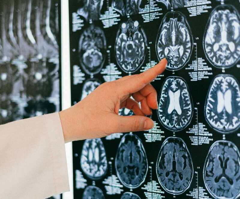 Adolescente atteinte d'hyperthymésie : elle se souvient de toute sa vie en détail  - Hypermnésie Hyperthymésie Santé